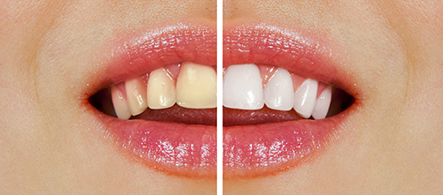 wybielanie zębów przed i po zabiegu